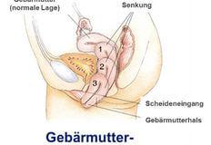 Gebärmuttersenkung: Symptome erkennen und richtig handeln Gebärmuttersenkung: Symptome erkennen und richtig handeln