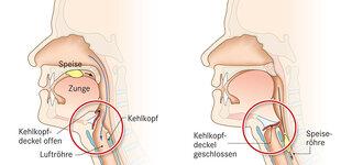 Behandlungsmöglichkeiten bei einem Kloßgefühl im Hals Behandlungsmöglichkeiten bei einem Kloßgefühl im Hals