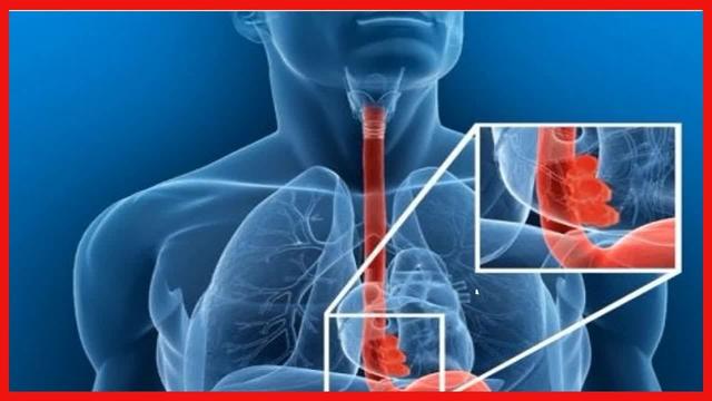 Psychosomatische Ursachen für das Globusgefühl und deren Behandlung Psychosomatische Ursachen für das Globusgefühl und deren Behandlung