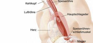 Refluxkrankheit als mögliche Ursache für Beschwerden in der Speiseröhre Refluxkrankheit als mögliche Ursache für Beschwerden in der Speiseröhre