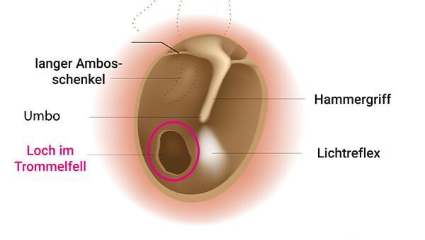 Symptome und Therapieoptionen bei einer Verletzung des Trommelfells Symptome und Therapieoptionen bei einer Verletzung des Trommelfells