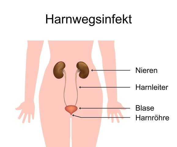 Harnwegsinfektion: Welche Komplikationen können auftreten?