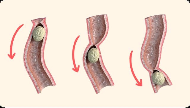 Effektive Lösungen für hartnäckige Verstopfung Effektive Lösungen für hartnäckige Verstopfung