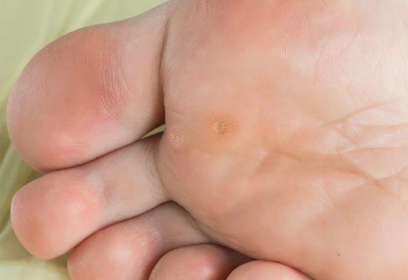 Was hilft gegen Hühneraugen? Effektive Methoden zur Behandlung Was hilft gegen Hühneraugen? Effektive Methoden zur Behandlung