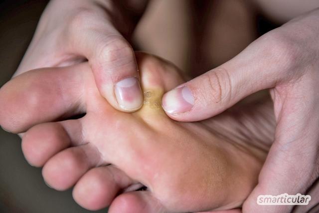 Hühneraugen loswerden: Hausmittel und andere Lösungsansätze Hühneraugen loswerden: Hausmittel und andere Lösungsansätze