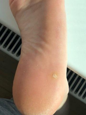 Schmerzende Hühneraugen? So entlasten Sie Ihre Füße effektiv Schmerzende Hühneraugen? So entlasten Sie Ihre Füße effektiv