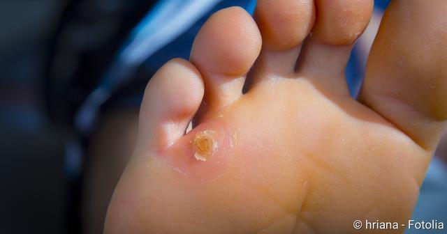 Expertentipps bei Hühneraugen: Ursachen, Vorbeugung und Behandlungsmöglichkeiten Expertentipps bei Hühneraugen: Ursachen, Vorbeugung und Behandlungsmöglichkeiten