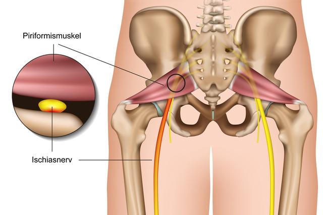 Ischiasschmerzen richtig behandeln: Expertenrat und bewährte Strategien
