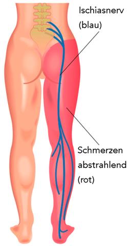 Ischiasschmerzen verstehen und bekämpfen: Ursachen, Symptome und Lösungsansätze