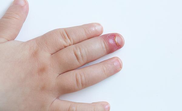 Komplikationen bei Nagelbettentzündungen: Risiken und Vorbeugung Komplikationen bei Nagelbettentzündungen: Risiken und Vorbeugung