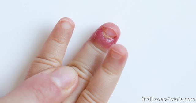 Chirurgische Eingriffe bei Nagelbettentzündungen: Was Sie wissen sollten Chirurgische Eingriffe bei Nagelbettentzündungen: Was Sie wissen sollten