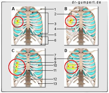 Behandlung eines Rippenbruchs: Schmerztherapie und Rehabilitationsmaßnahmen