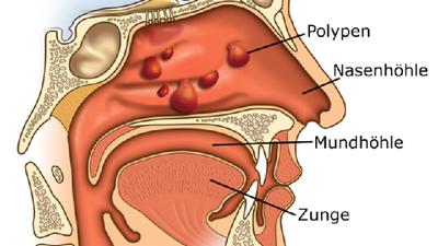 Ursachen für eine verstopfte Nase: Erkältung, Allergie oder anatomische Veränderungen?