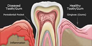 Unterschied zwischen Parodontitis und Gingivitis: Erklärung der beiden Erkrankungen Unterschied zwischen Parodontitis und Gingivitis: Erklärung der beiden Erkrankungen