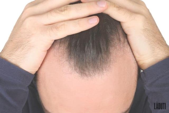 Geheimratsecken bekämpfen: Tipps und Tricks Geheimratsecken bekämpfen: Tipps und Tricks