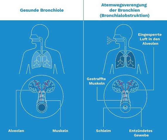 Giemen als Anzeichen für Asthma, COPD oder Bronchitis: Was Sie wissen sollten Giemen als Anzeichen für Asthma, COPD oder Bronchitis: Was Sie wissen sollten