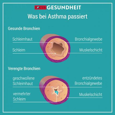 Giemen bei verengten Bronchien: Symptome und Maßnahmen Giemen bei verengten Bronchien: Symptome und Maßnahmen