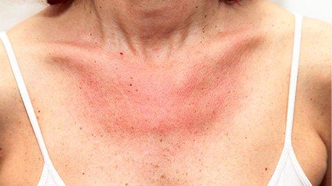 Hitzepickel loswerden: Effektive Maßnahmen zur Behandlung Hitzepickel loswerden: Effektive Maßnahmen zur Behandlung