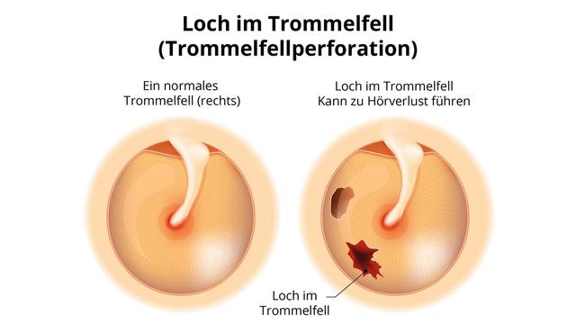 1. Symptome und Behandlung eines Trommelfellrisses