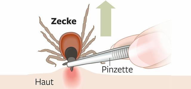 Erste Hilfe bei einem abgerissenen Zeckenstich Erste Hilfe bei einem abgerissenen Zeckenstich