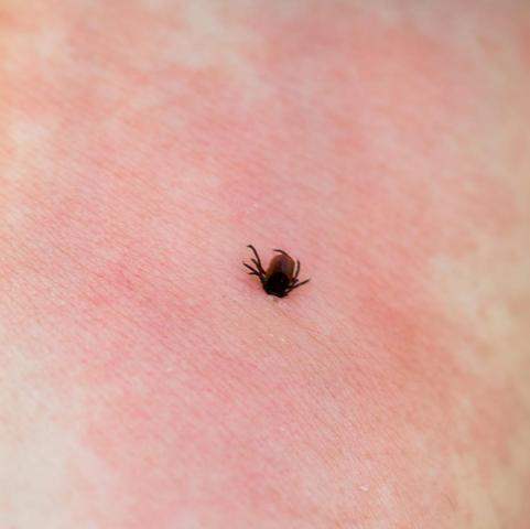 Sofortmaßnahmen nach einem abgerissenen Zeckenstich Sofortmaßnahmen nach einem abgerissenen Zeckenstich
