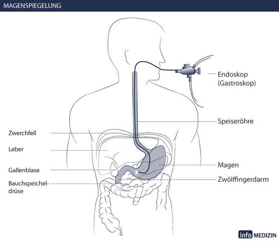 Gastroskopie: Welche Ergebnisse liefert sie? Gastroskopie: Welche Ergebnisse liefert sie?