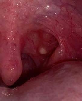 Weiße Stippchen im Rachen: Maßnahmen zur Linderung und Heilung Weiße Stippchen im Rachen: Maßnahmen zur Linderung und Heilung