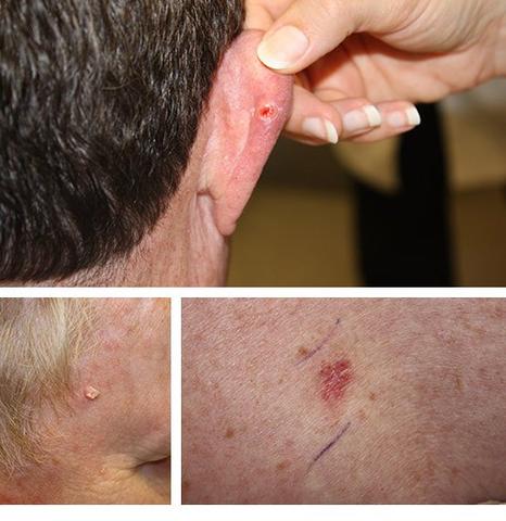 Was ist weißer Hautkrebs und wie sieht er aus?