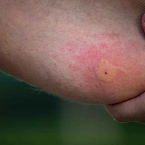 Juckende und brennende Stiche: Identifizierung der Tiere, die mich gestochen haben Juckende und brennende Stiche: Identifizierung der Tiere, die mich gestochen haben