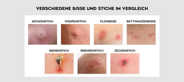 Welche Tiere haben mich gestochen? Eine Übersicht über verschiedene Insektenstiche Welche Tiere haben mich gestochen? Eine Übersicht über verschiedene Insektenstiche