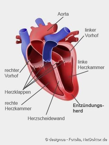 Behandlung einer Herzmuskelentzündung: Maßnahmen und mögliche Komplikationen Behandlung einer Herzmuskelentzündung: Maßnahmen und mögliche Komplikationen