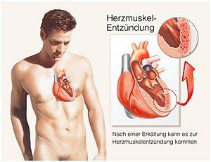 Wohin wenden bei einer Herzmuskelentzündung? Informationen und Kontaktmöglichkeiten Wohin wenden bei einer Herzmuskelentzündung? Informationen und Kontaktmöglichkeiten