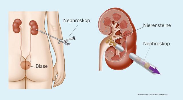 Die Entstehung von Nierensteinen: Ein Überblick über mögliche Ursachen