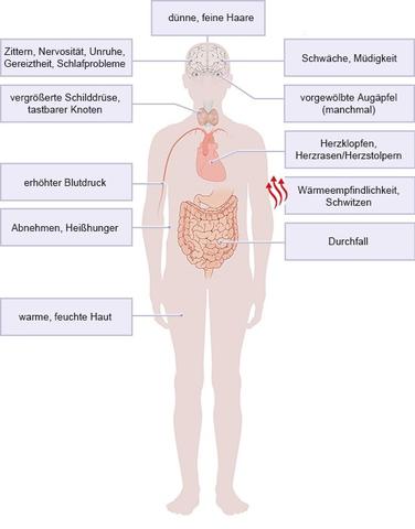 Typische Merkmale einer Schilddrüsenunterfunktion: Was sind die Anzeichen? Typische Merkmale einer Schilddrüsenunterfunktion: Was sind die Anzeichen?