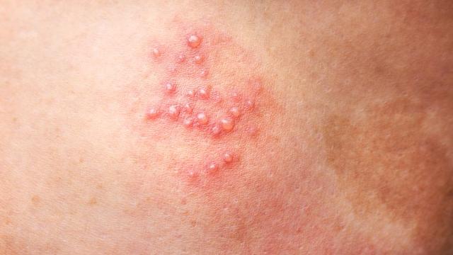 Gürtelrose im frühen Stadium: So sieht der Hautausschlag aus