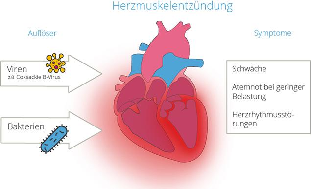 Ursachen einer Herzmuskelentzündung: Ursachen einer Herzmuskelentzündung: