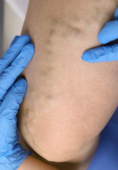 Beinvenenthrombose erkennen: Symptome und Maßnahmen Beinvenenthrombose erkennen: Symptome und Maßnahmen