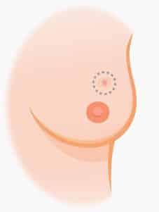 Knoten in der Brust: Wie sieht Brustkrebs aus? Bilder und Beschreibung Knoten in der Brust: Wie sieht Brustkrebs aus? Bilder und Beschreibung