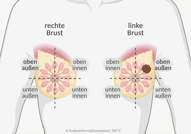 Knoten in der Brust: Visuelle Darstellung von Brustkrebs Knoten in der Brust: Visuelle Darstellung von Brustkrebs