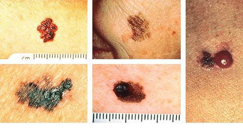 Typische äußere Merkmale und Erscheinung von schwarzem Hautkrebs