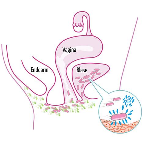 Was sind die typischen Anzeichen einer Blasenentzündung? Was sind die typischen Anzeichen einer Blasenentzündung?