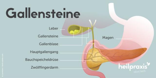Wie entstehen Gallensteine? Ursachen und Mechanismen erklärt Wie entstehen Gallensteine? Ursachen und Mechanismen erklärt