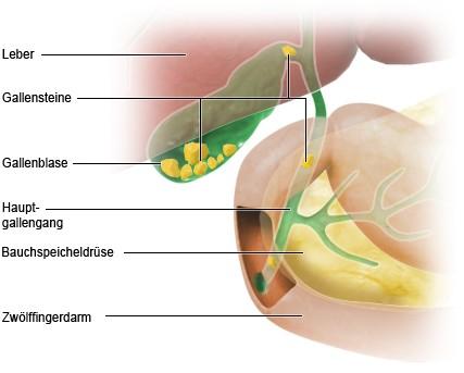 Ursachen und Risikofaktoren für die Entstehung von Gallensteinen Ursachen und Risikofaktoren für die Entstehung von Gallensteinen