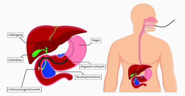 Sterben mit Gallengangskarzinom: Was Betroffene und Angehörige wissen sollten Sterben mit Gallengangskarzinom: Was Betroffene und Angehörige wissen sollten