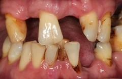 Wie kann ich meinen lockeren Zahn wieder festigen? Wie kann ich meinen lockeren Zahn wieder festigen?