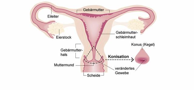 Warum ist Bettruhe nach einer Konisation wichtig?