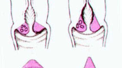 Empfohlene Ruhezeit nach einer Konisation