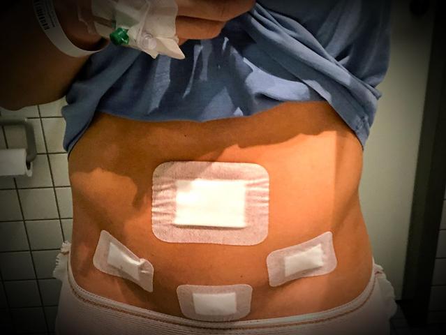 Die Dauer bis zur Auflösung der inneren Fäden nach einer Gebärmutterentfernung