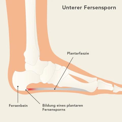 Behandlung von Fersensporn: Wie lange bleibt man krankgeschrieben?