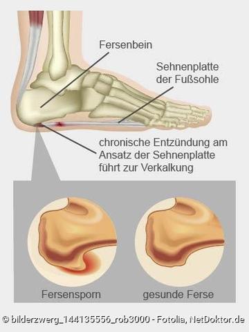 Fersensporn: Wie lange dauert die Genesungszeit und was kann man tun?